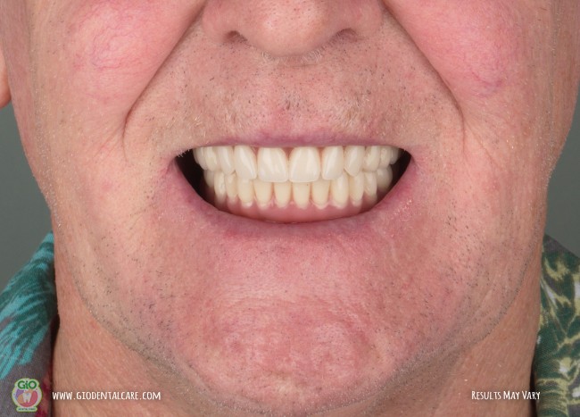 gio-dental-implants--implan-gigi